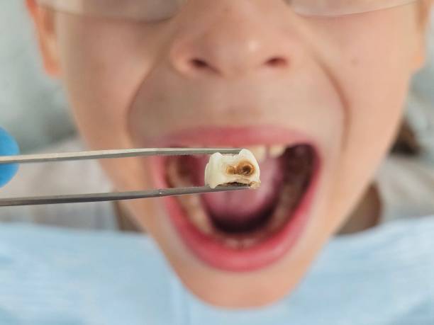 Best Emergency Dental Care for Broken or Chipped Teeth in Park Rapids, MN